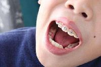 【健康解碼】矯正牙齒真的可以瘦臉嗎？